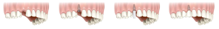 implant nasıl yapılır