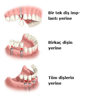 Hangi Durumlarda İmplant Yapılır?